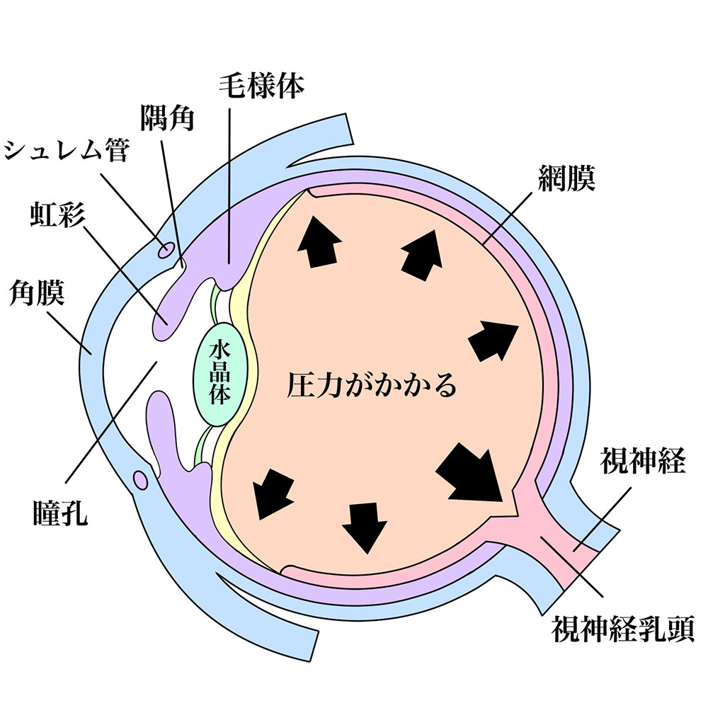 緑内障