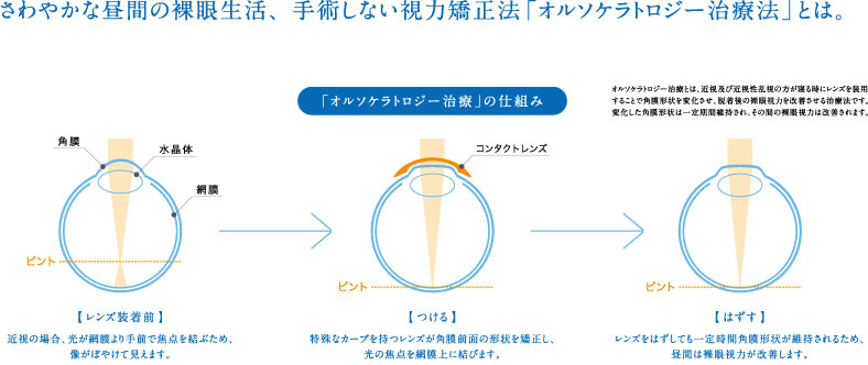 オルソケラトロジー